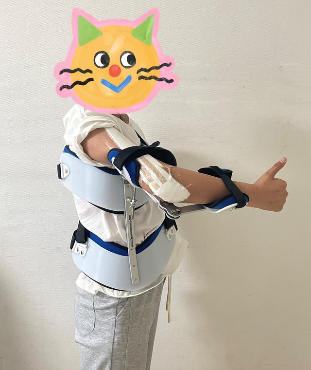 13歲少女患骨肉瘤面臨截肢，3D打印肱骨假體治療成功保肢